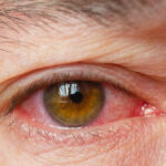 Pink eye emerges as new Covid symptom